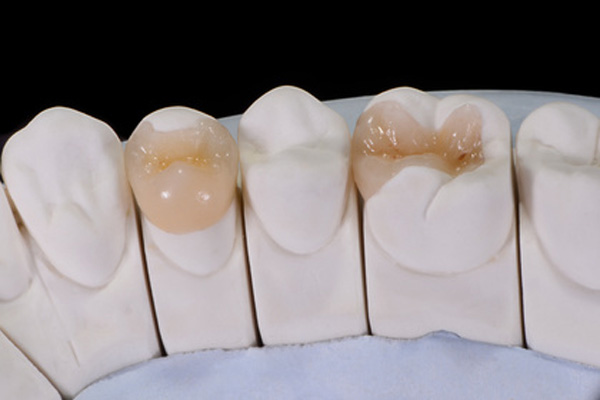 Dental Shape Bremen Onlays