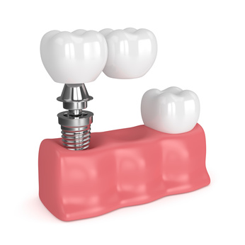 Dental Shape Bremen Implantat